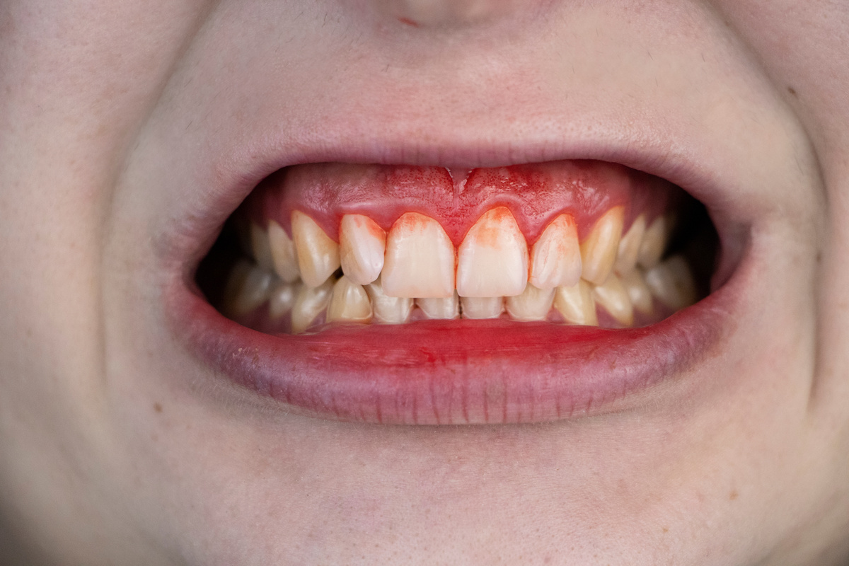 Gum Bleeding and Inflammation 
