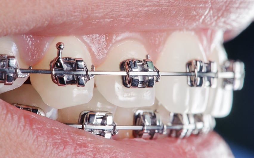 Close-up dental braces on teeth. Orthodontic Treatment